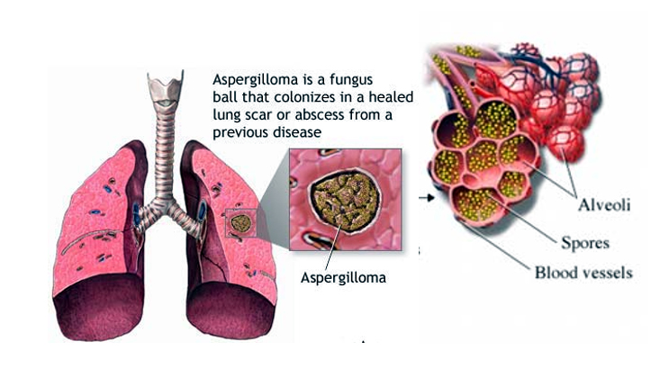 Aspergilloma